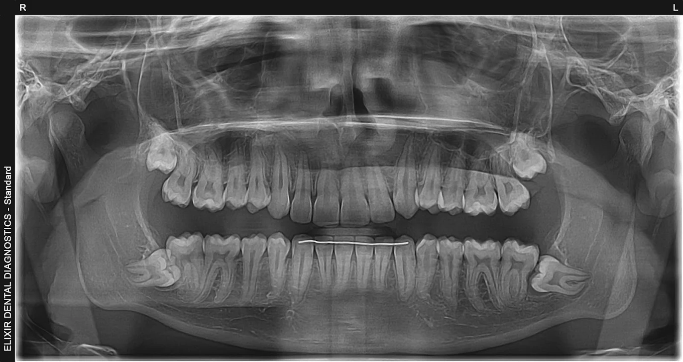 Sample OPG panoramic X-ray from Elixir Dental Diagnostics